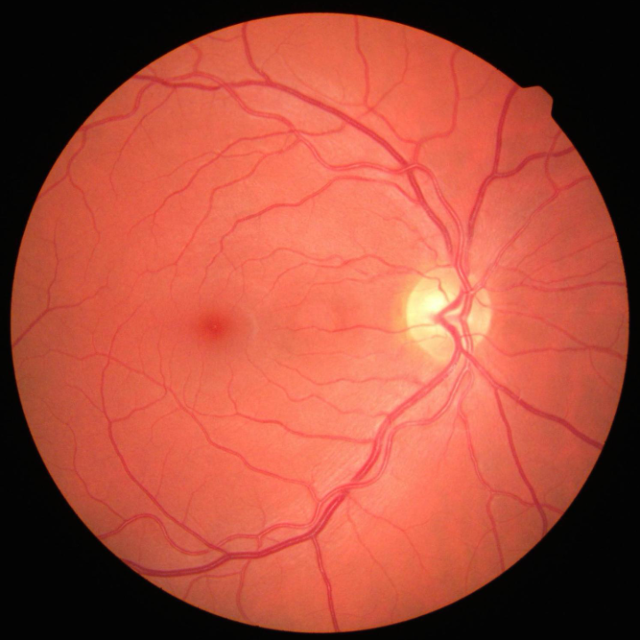 Fundus photograph of the retina